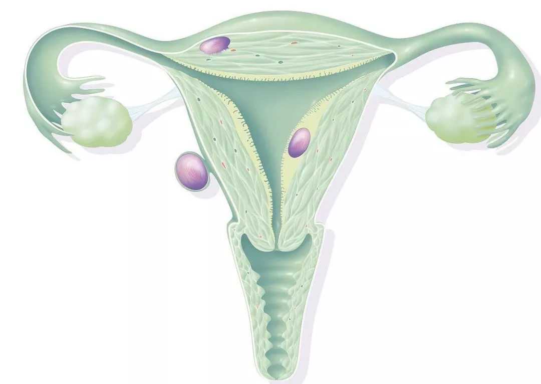 痛经、不孕……这些可能是你的子宫内膜异位症在作祟